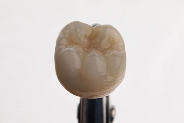 Reasons Why A Dentist May Recommend A Dental Crown
